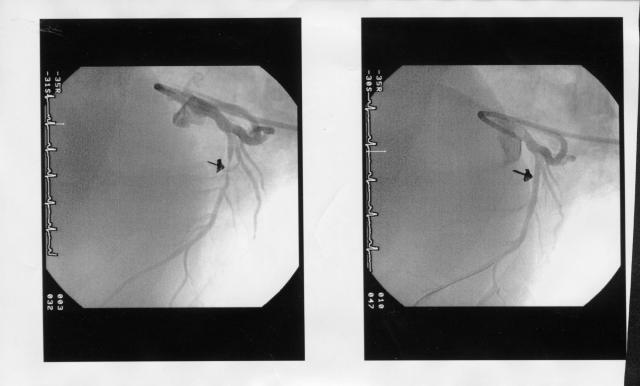 angioplasty